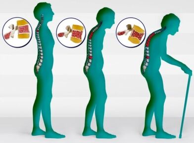 Osteoporozė